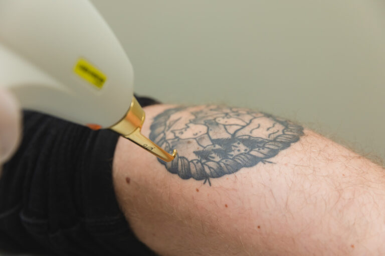 Tattoo Removal